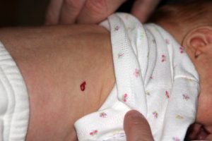 are heart-shaped birthmarks rare