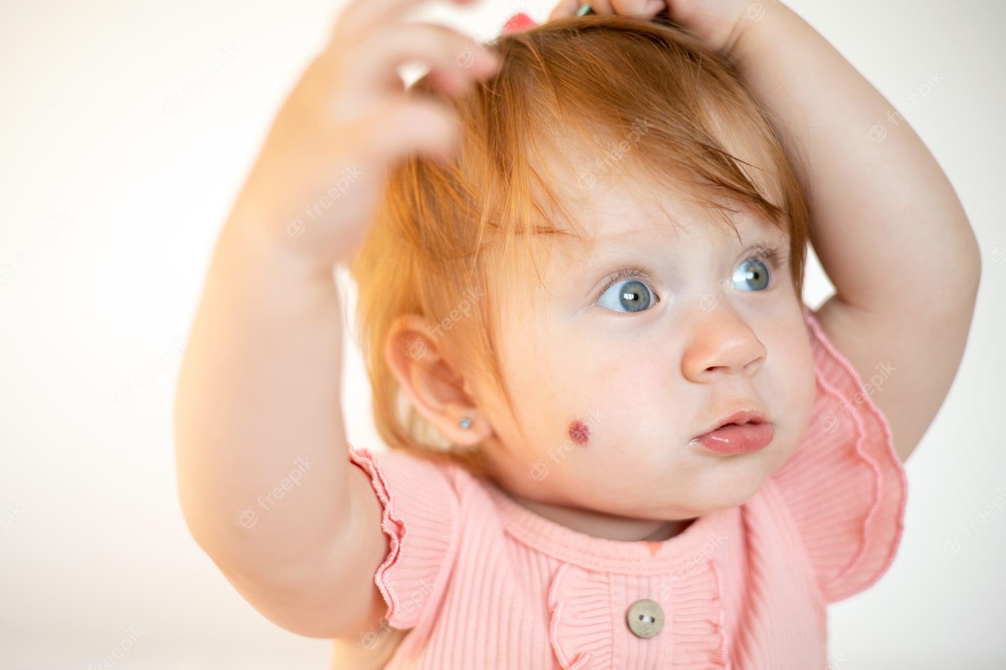 red-birthmark-on-the-face-causes-types-and-treatment-options-itechment